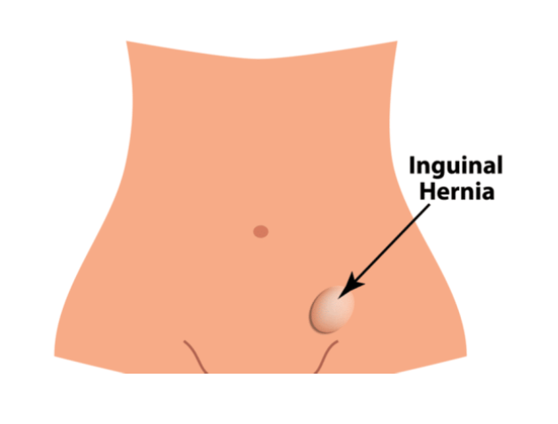 inguinal_hernia